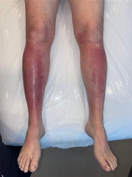 Queimadura solar em perna, com vermelhidão intensa, antes do tratamento com FlamiActiv®