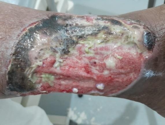 Lesão vascular em membro inferior com tecido necrótico, antes do tratamento com Flaminal® Hydro